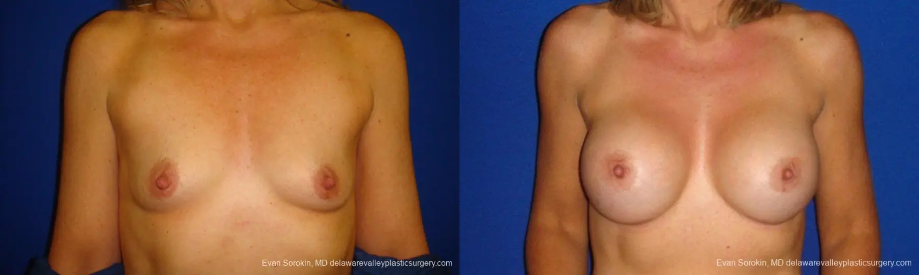 Philadelphia Breast Augmentation 9412 - Before and After 1