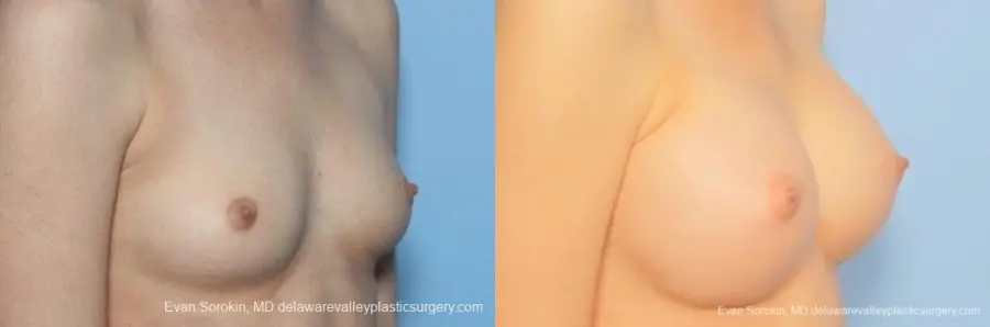 Philadelphia Breast Augmentation 8771 - Before and After 2