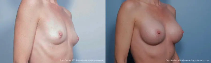 Philadelphia Breast Augmentation 9459 - Before and After 2
