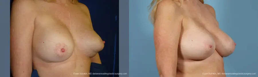 Philadelphia Breast Augmentation 9457 - Before and After 4