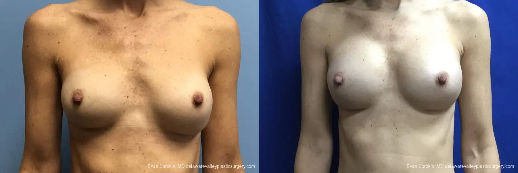 Breast Augmentation Revision: Patient 30 - Before and After 1