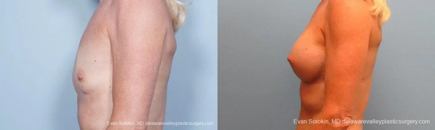 Philadelphia Breast Augmentation 9415 - Before and After 5