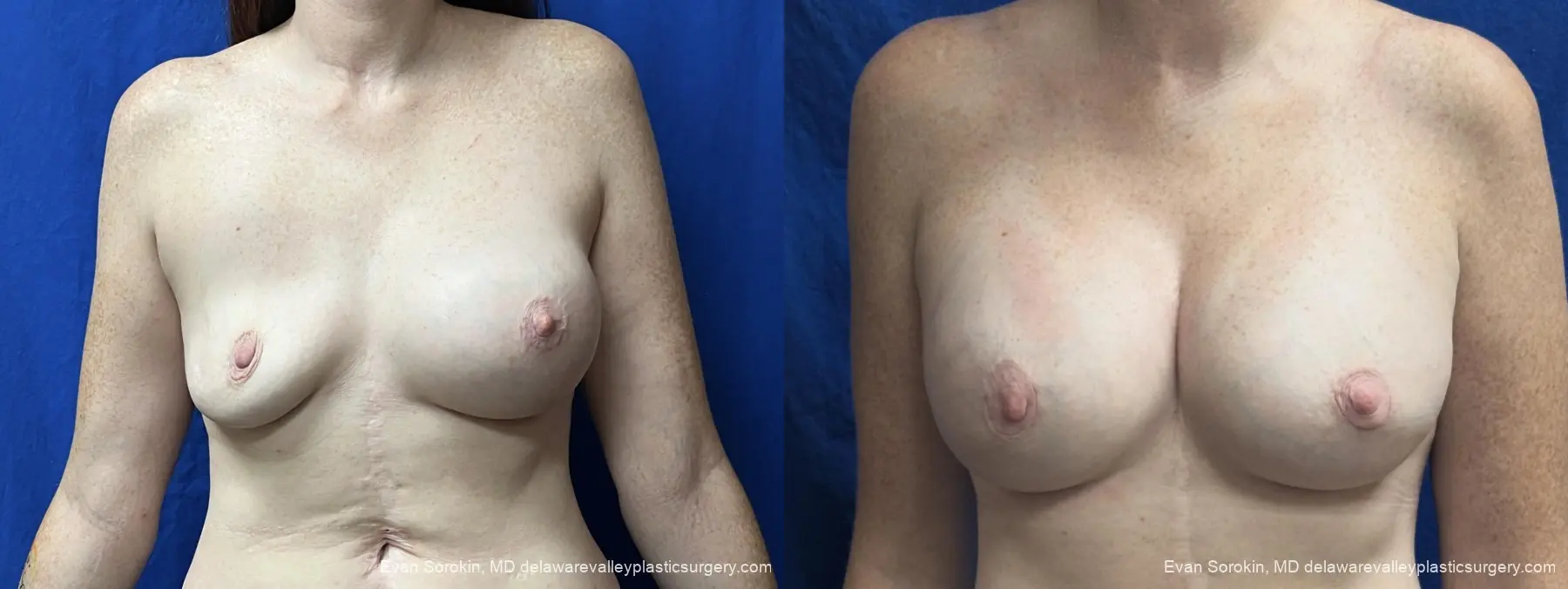 Breast Augmentation: Patient 299 - Before and After 1