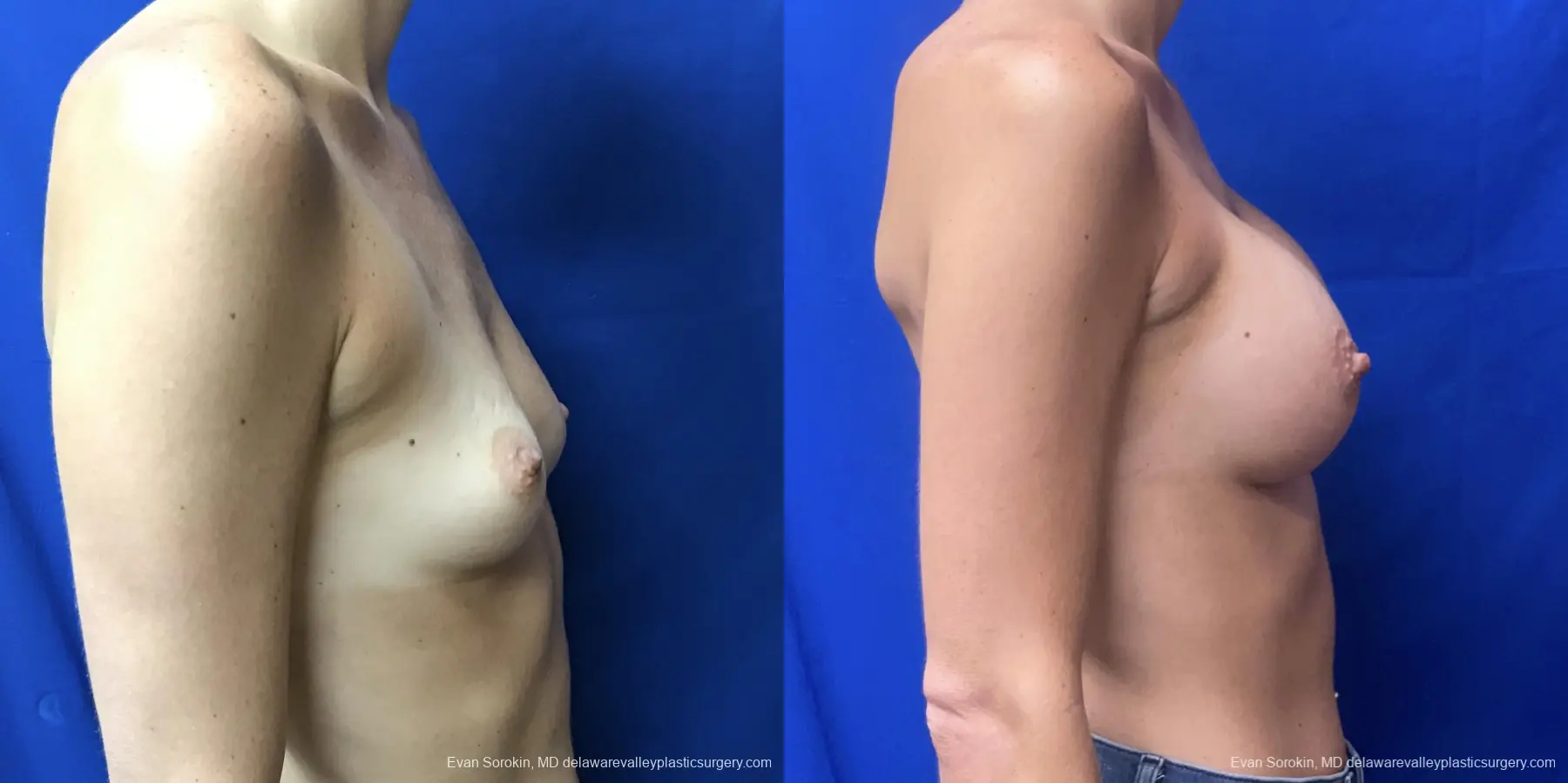 Breast Augmentation: Patient 184 - Before and After 3