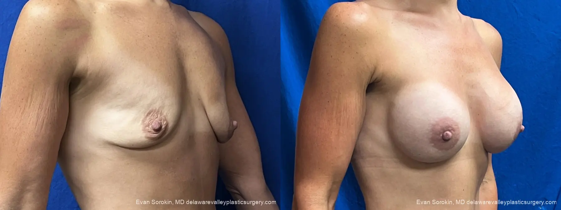Breast Augmentation: Patient 305 - Before and After 2