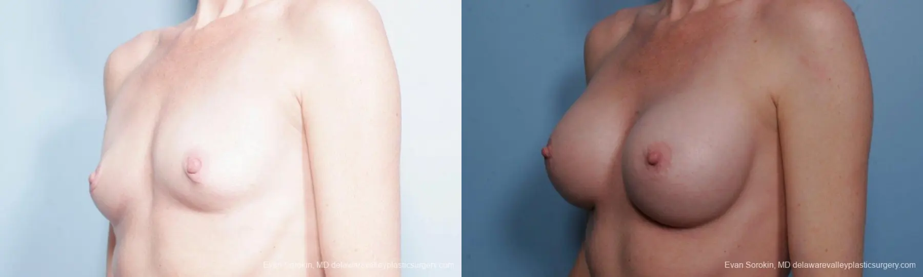 Philadelphia Breast Augmentation 9359 - Before and After 4