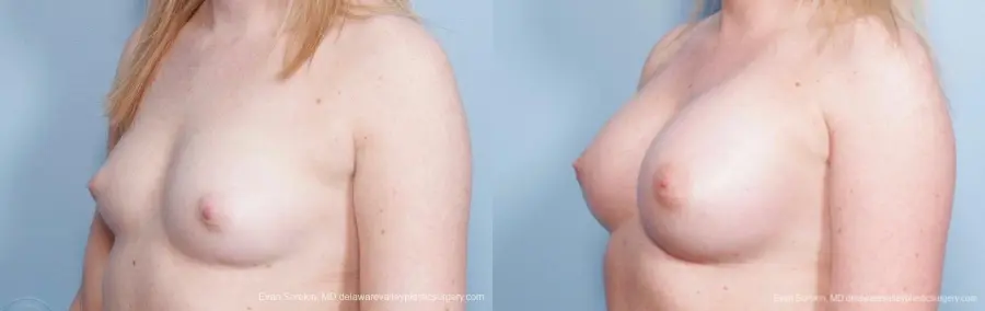 Philadelphia Breast Augmentation 8778 - Before and After 3