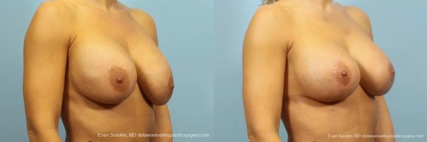 Philadelphia Breast Augmentation 8709 - Before and After 2