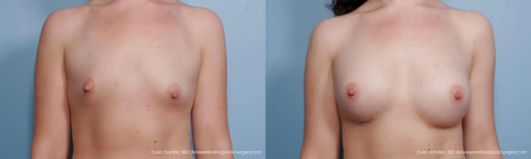 Philadelphia Breast Augmentation 9176 - Before and After 1