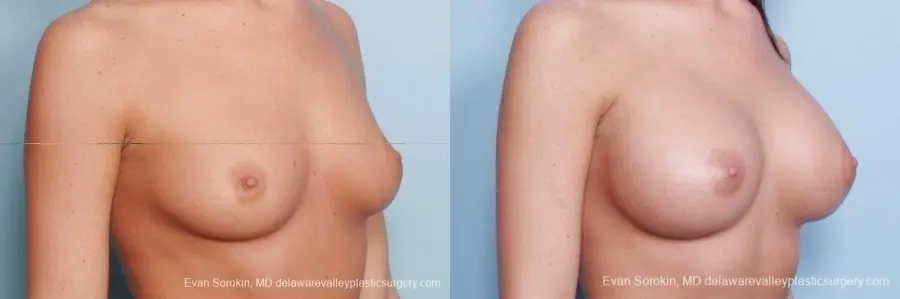 Philadelphia Breast Augmentation 8792 - Before and After 2