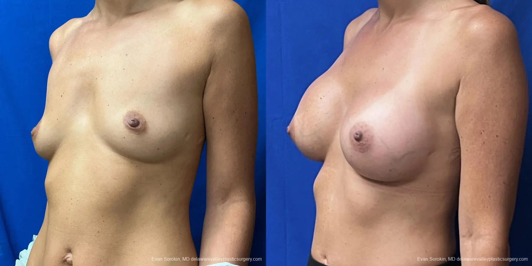 Breast Augmentation: Patient 230 - Before and After 4
