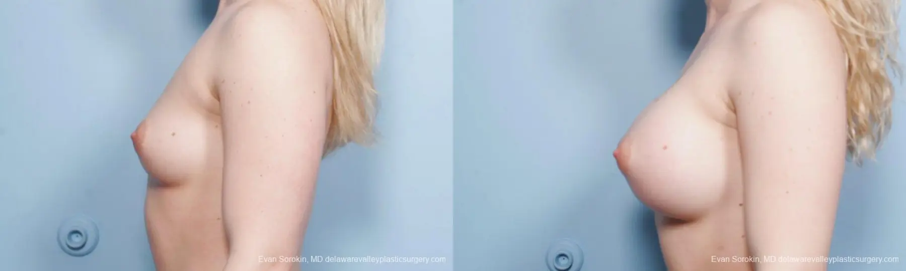 Breast Augmentation: Patient 147 - Before and After 5
