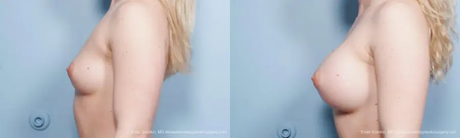 Breast Augmentation: Patient 129 - Before and After 5