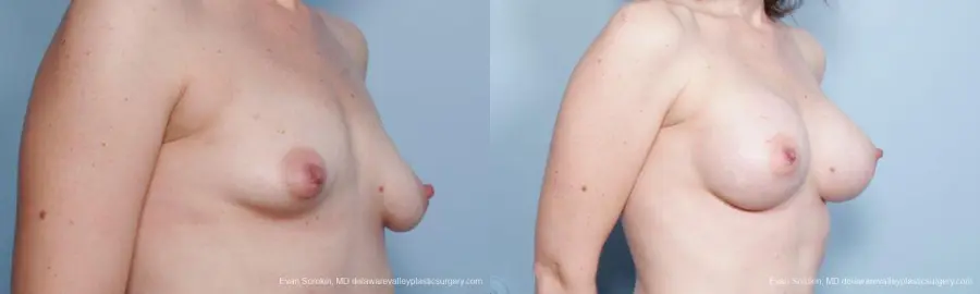 Philadelphia Breast Augmentation 9302 - Before and After 2