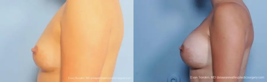 Philadelphia Breast Augmentation 8797 - Before and After 5
