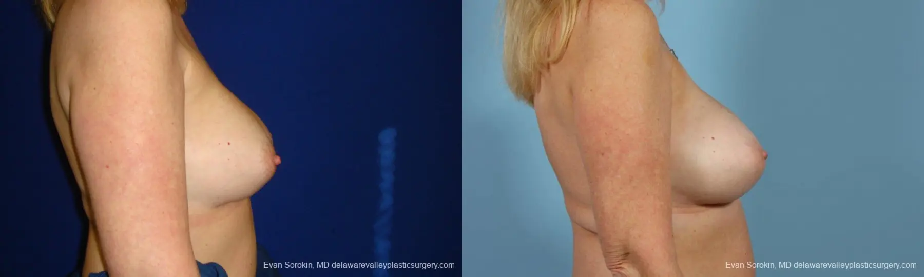 Philadelphia Breast Augmentation 9457 - Before and After 5