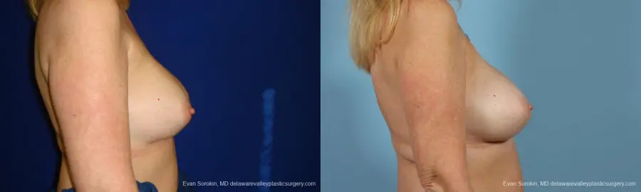 Philadelphia Breast Augmentation 9457 - Before and After 5