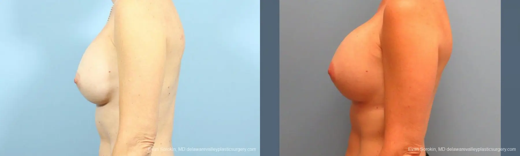Philadelphia Breast Augmentation 9456 - Before and After 5