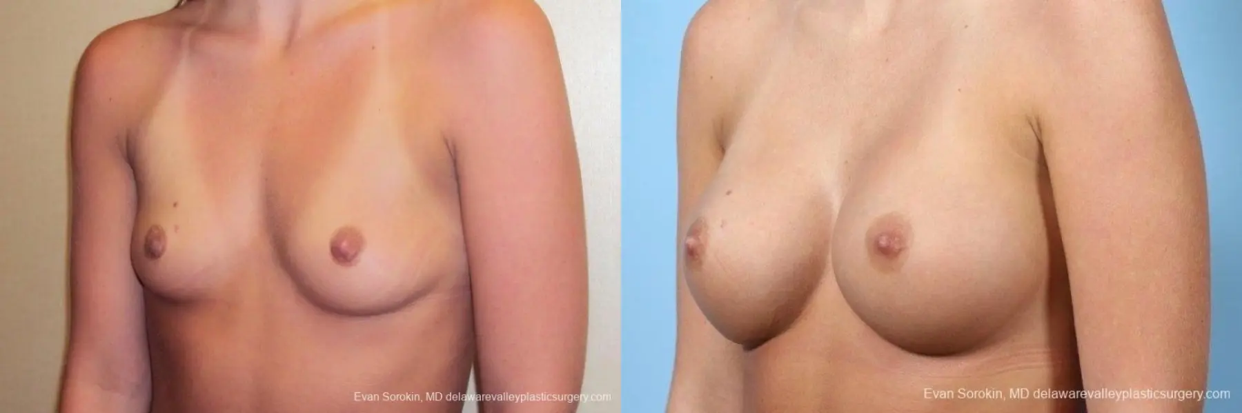 Philadelphia Breast Augmentation 8772 - Before and After 3