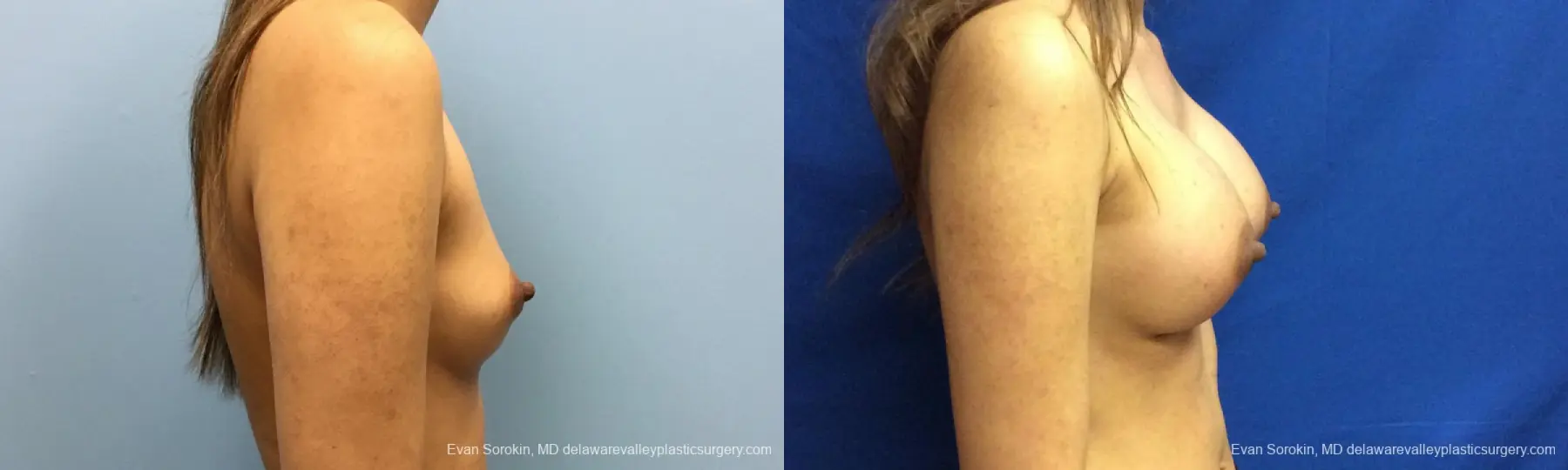 Philadelphia Breast Augmentation 12515 - Before and After 4