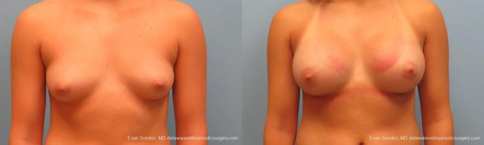 Philadelphia Breast Augmentation 9386 - Before and After 1