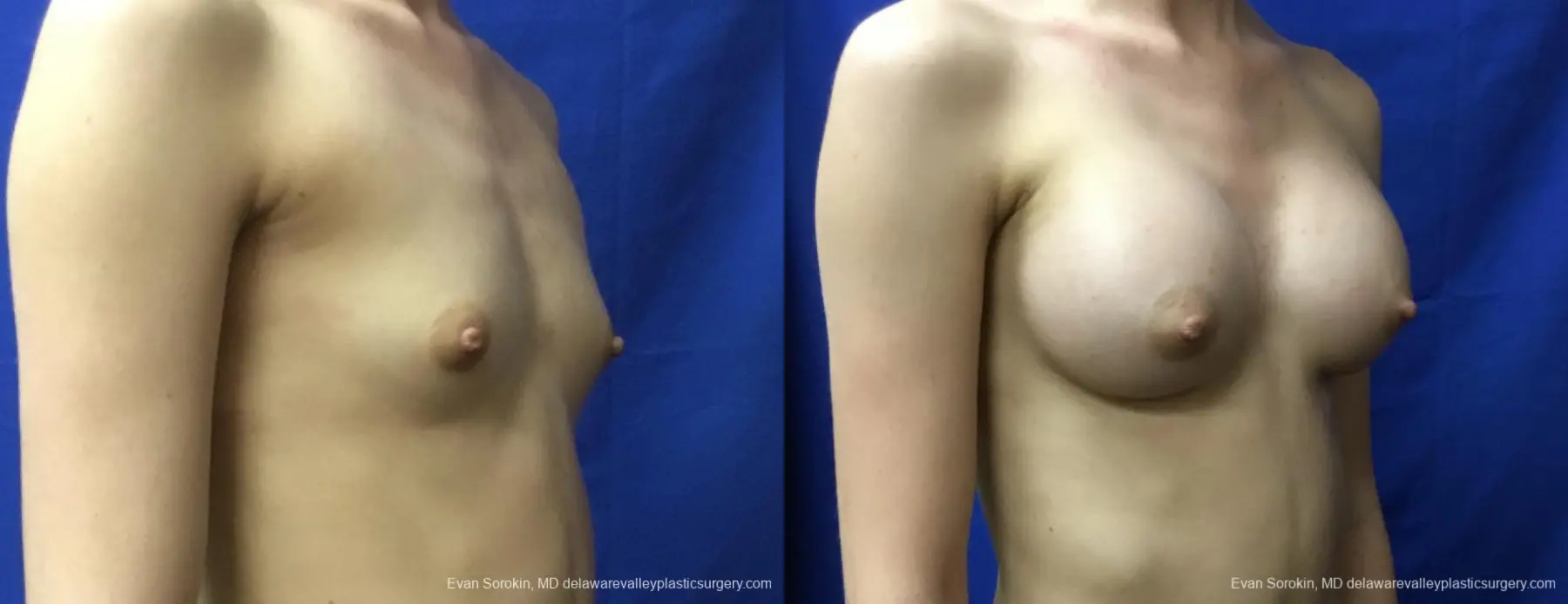 Breast Augmentation: Patient 161 - Before and After 2