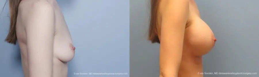 Philadelphia Breast Augmentation 8781 - Before and After 4