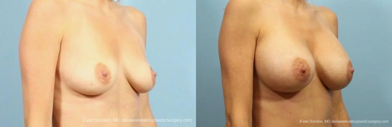 Philadelphia Breast Augmentation 8782 - Before and After 2