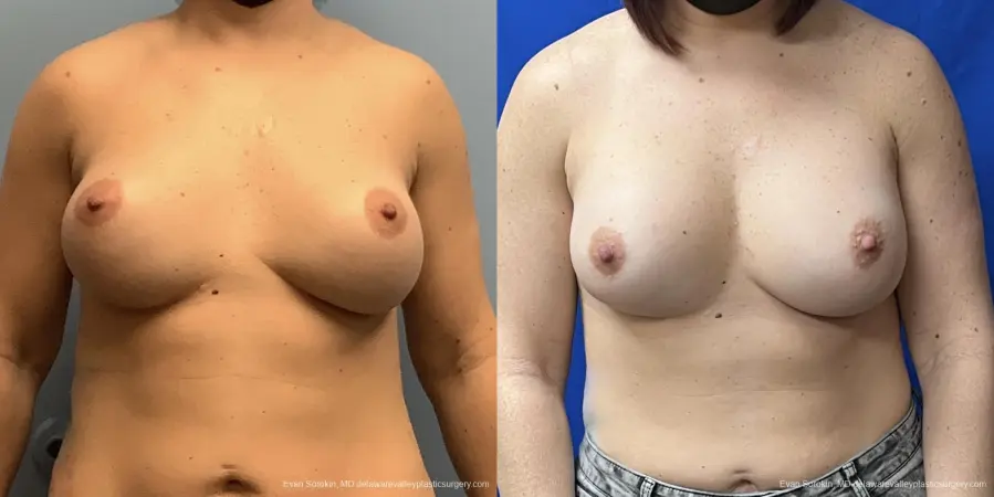 Breast Augmentation Revision: Patient 31 - Before and After 1