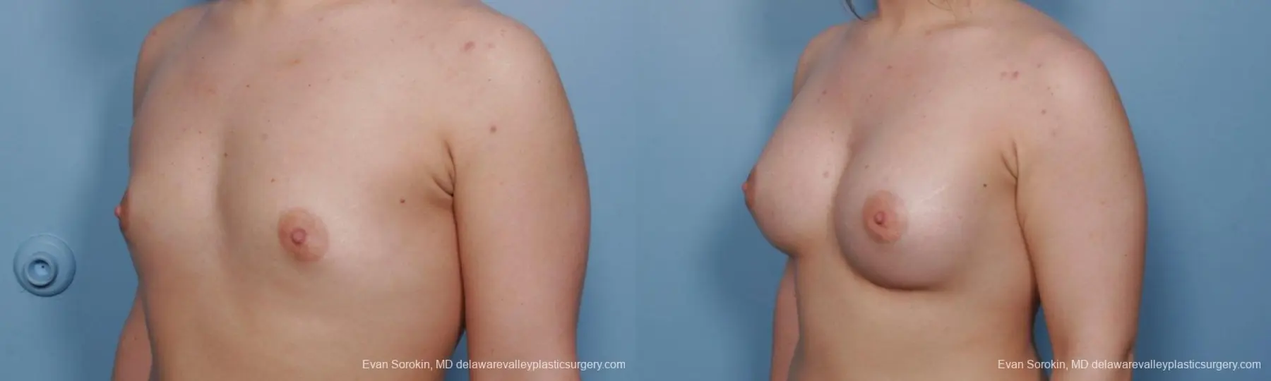 Philadelphia Breast Augmentation 9378 - Before and After 4