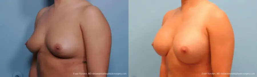 Philadelphia Breast Augmentation 9383 - Before and After 4