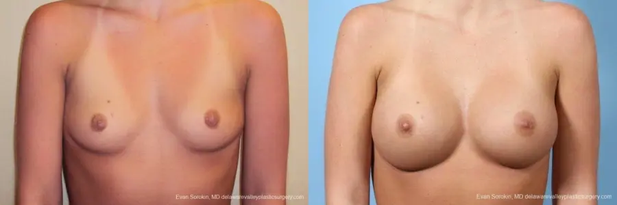 Philadelphia Breast Augmentation 8772 - Before and After 1