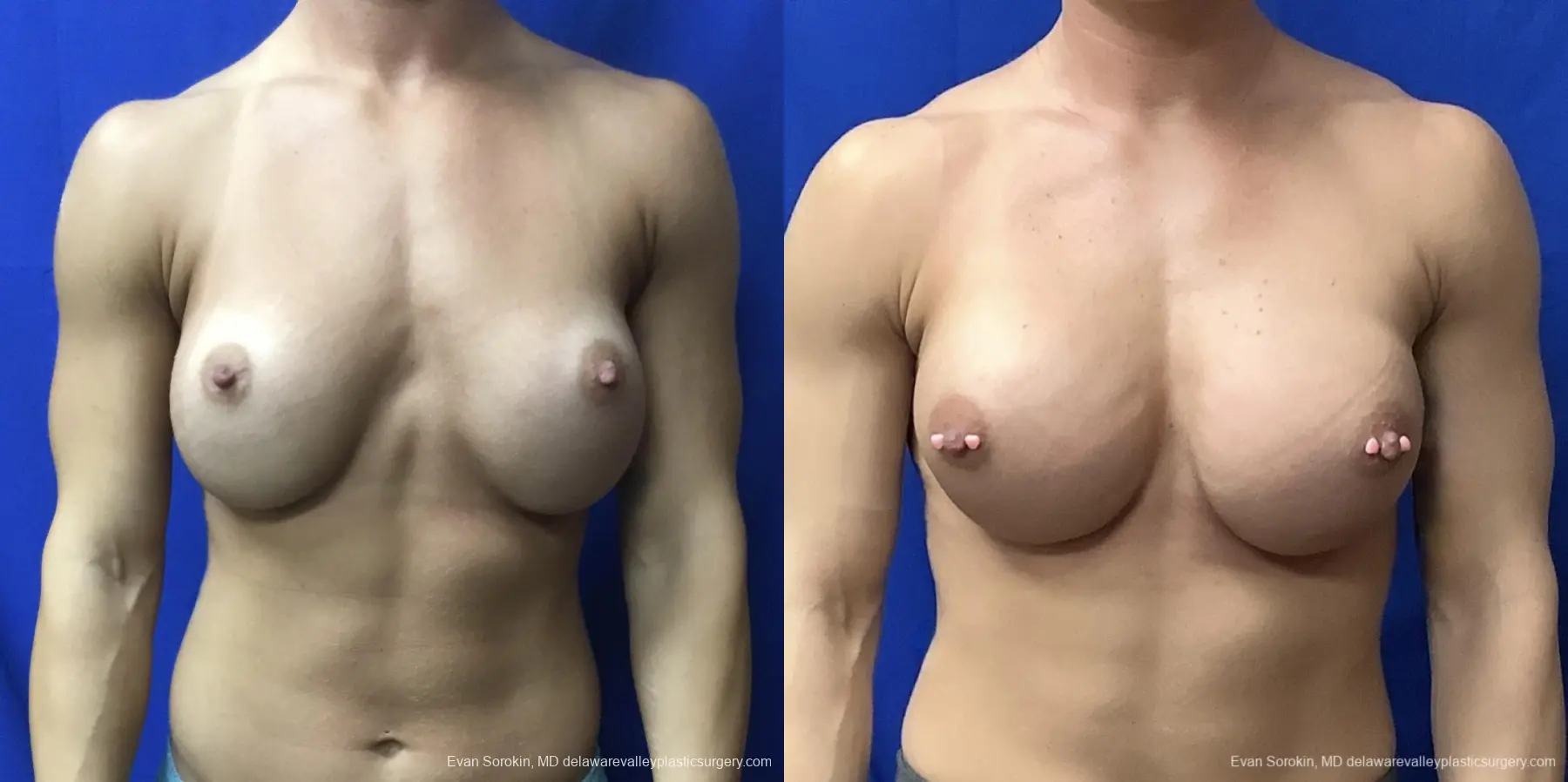 Breast Augmentation Revision: Patient 29 - Before and After 1