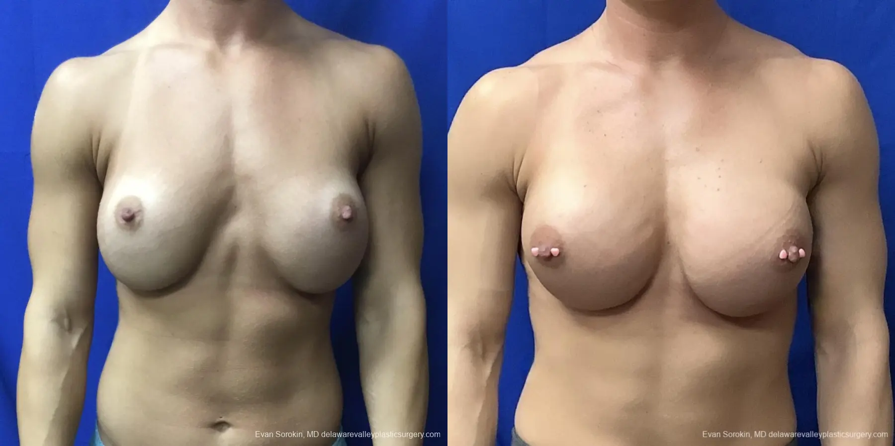 Breast-augmentation-revision: Patient 29 - Before and After  