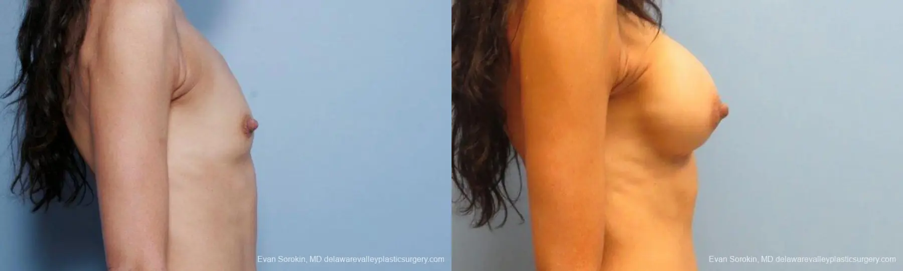 Philadelphia Breast Augmentation 9424 - Before and After 3