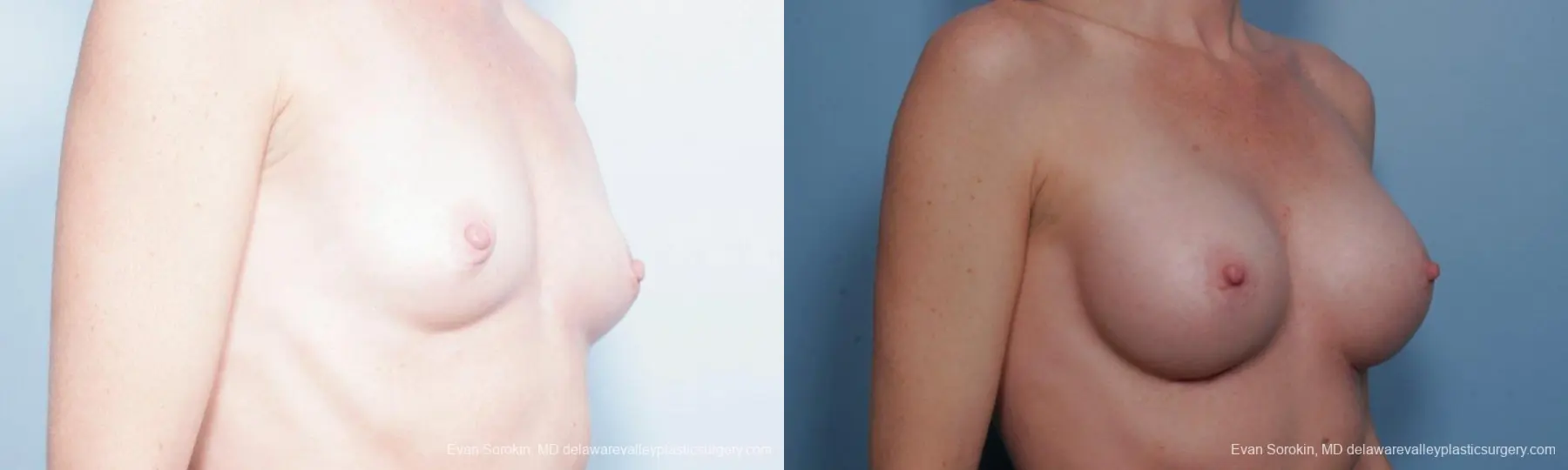 Philadelphia Breast Augmentation 9359 - Before and After 2