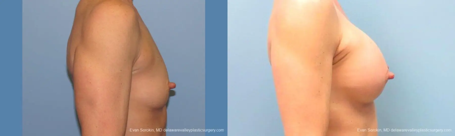 Philadelphia Breast Augmentation 9744 - Before and After 3