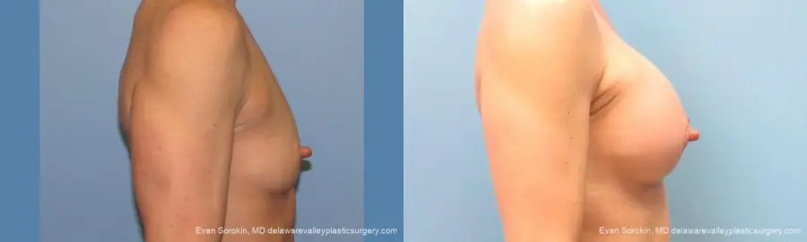 Philadelphia Breast Augmentation 9744 - Before and After 3