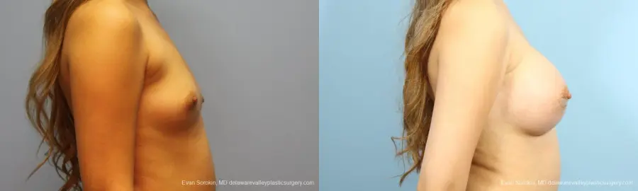 Philadelphia Breast Augmentation 9194 - Before and After 3