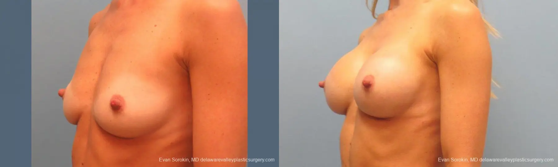 Philadelphia Breast Augmentation 9397 - Before and After 4