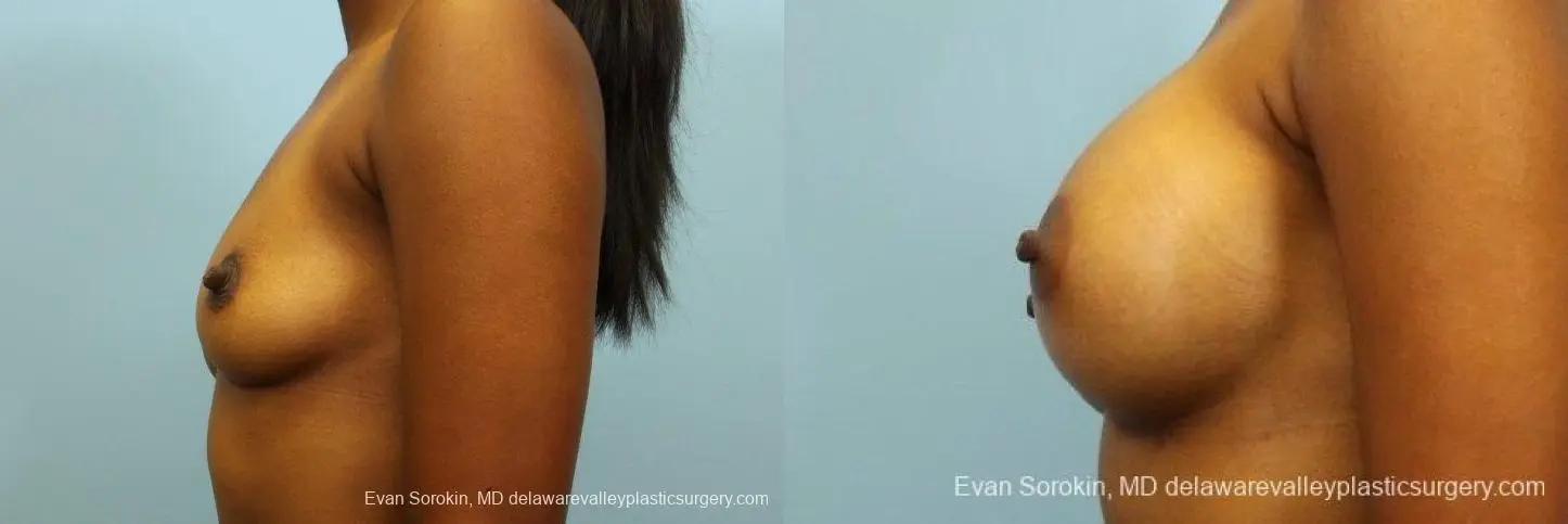 Philadelphia Breast Augmentation 8768 - Before and After 5