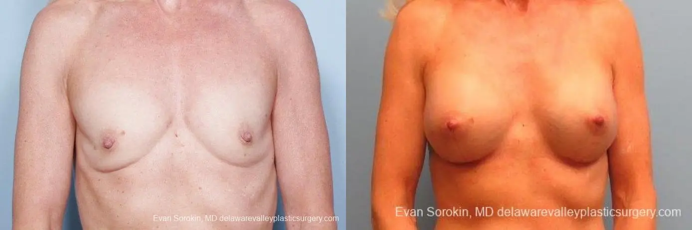 Philadelphia Breast Augmentation 9415 - Before and After 1