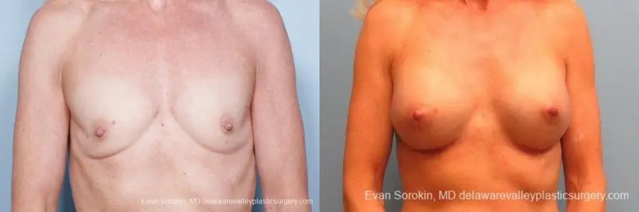 Philadelphia Breast Augmentation 9415 - Before and After 1