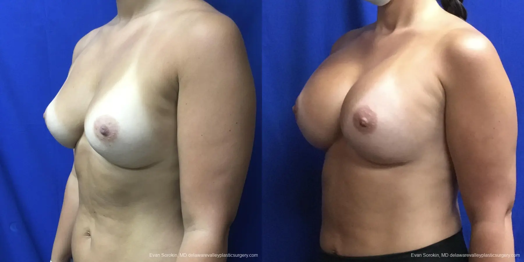 Breast Augmentation: Patient 206 - Before and After 4