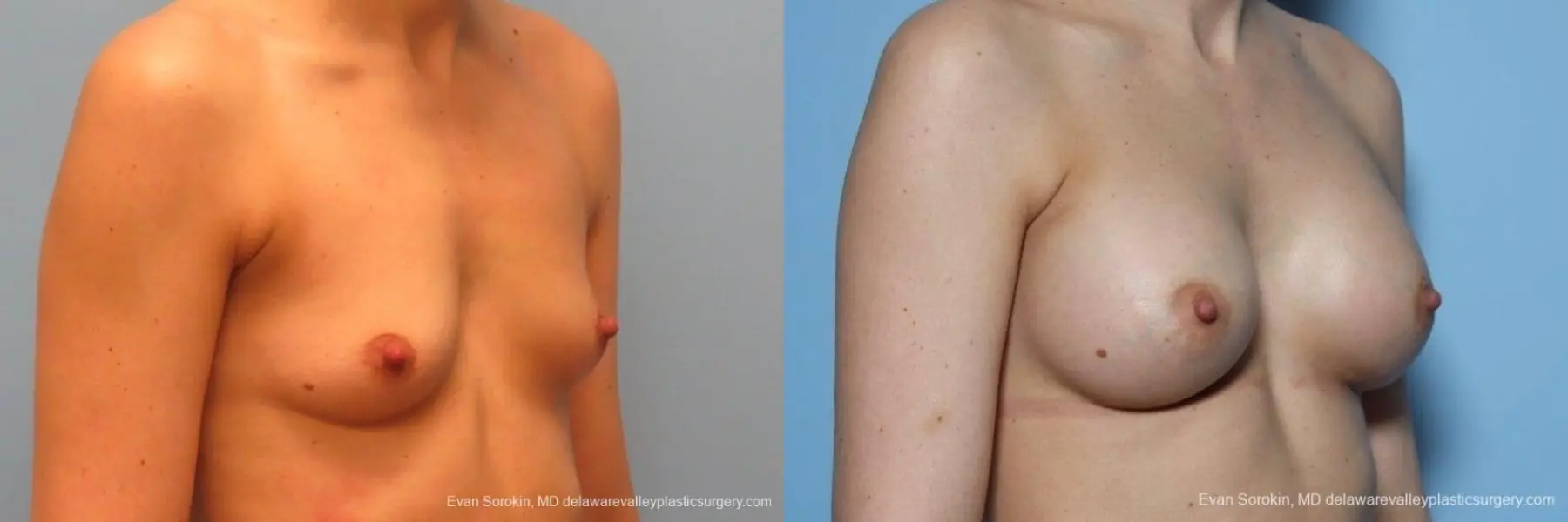 Philadelphia Breast Augmentation 8763 - Before and After 2