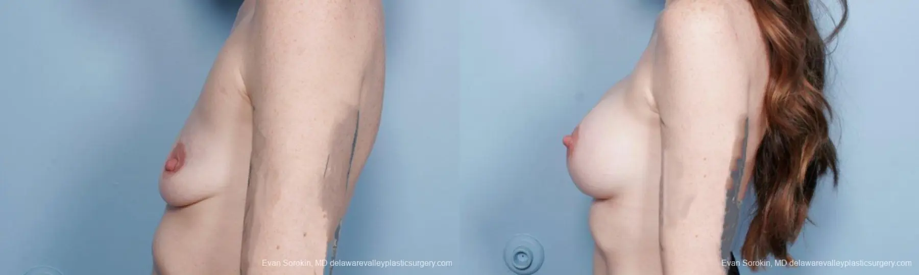 Philadelphia Breast Augmentation 8649 - Before and After 5