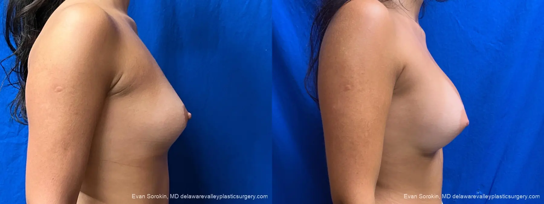 Breast Augmentation: Patient 314 - Before and After 3