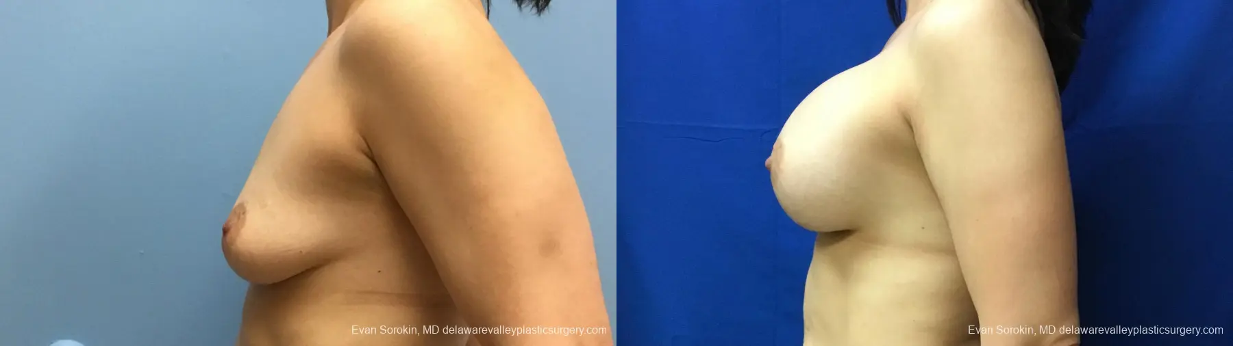 Philadelphia Breast Augmentation 12541 - Before and After 5