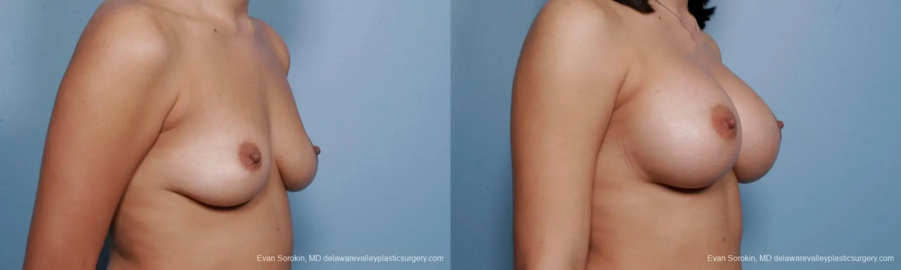 Philadelphia Breast Augmentation 9373 - Before and After 2