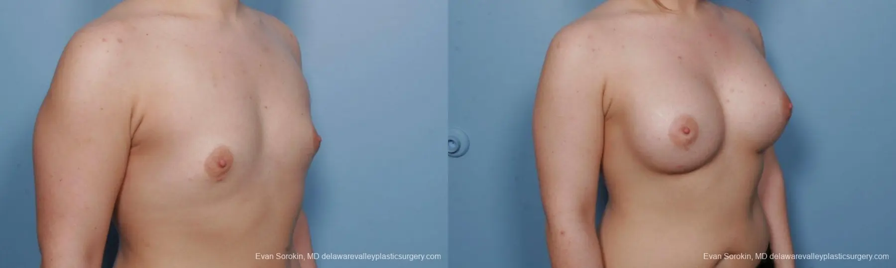 Philadelphia Breast Augmentation 9378 - Before and After 2